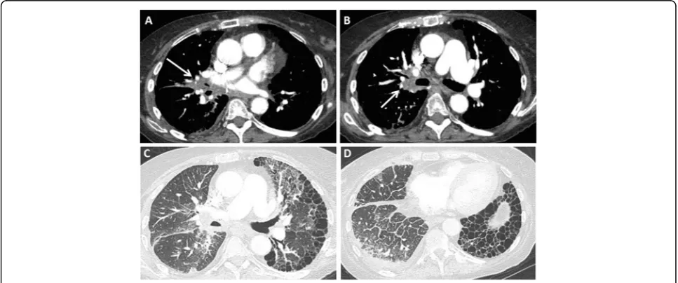 Fig. 4 Patient with bilateral lung transplant and mild acute cellular rejection. Axial CT images (a–d) show asymmetric (right more than left)patchy and nodular peribronchial ground glass opacities (arrows) with basilar peribronchial consolidative opacities
