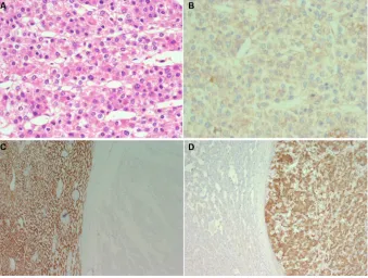 Figure 1 eighty-year-old woman with a large intrahepatic tumor in the right lobe suspect for hepatocellular carcinoma.Notes: Histological examination of the resected specimen shows (A; H&e) that the tumor is composed of solid sheets or trabeculae of medium