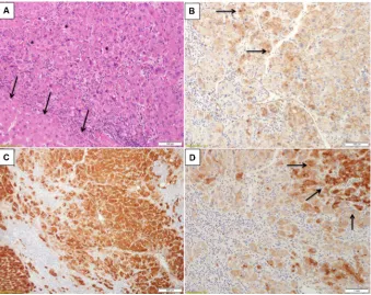 Figure 3 Inflammatory hepatocellular adenoma with focal signs of concomitant beta-catenin activation.Notes: (A) H&e section showed an area of increased cell density (asterisks) in comparison to a nearby one in which hepatocytes are more of normal size (arr