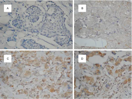 Figure 2. Stained by immunohistochemistry using the primary antibody againts SNCG (×200); A