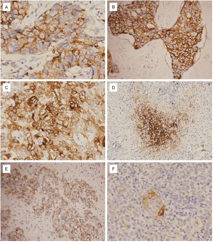 Figure 2. Results of immunostaining for CD5, CD117, GLUT-1 and MUC-1. A. CD5 immunostaining in a TSCC, EnVi-sion ×400