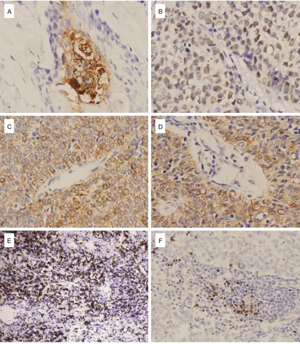 Figure 3. Results of immunostaining for CEA, P63, CK5/6, CK19, CD1a and TdT. A. CEA immunostaining in a TSCC, EnVision ×400