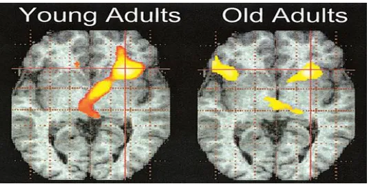 Figure 3.1 An example of the HAROLD pattern. Activity in the young adults is mainly restricted to the right hemisphere