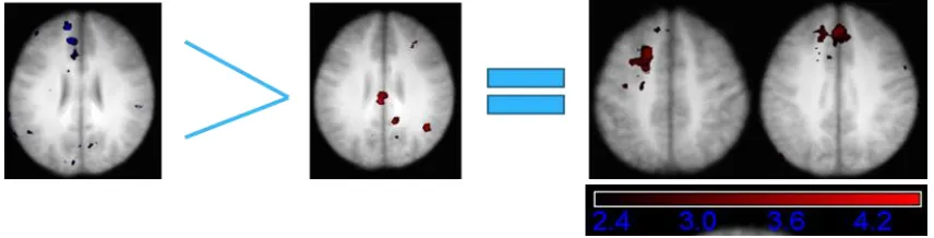 Figure 8.4 Results of conjunction analysis. Areas, in common to both groups, showing a greater relative signal increase for on accurate critical trials compared against accurate consistent trials