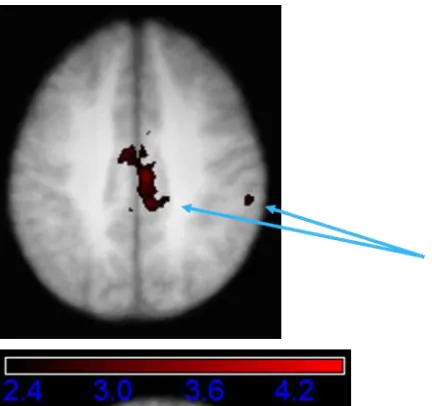 Figure 8.6 Areas showing a greater relative signal increase on accurate critical trials compared against false critical trials