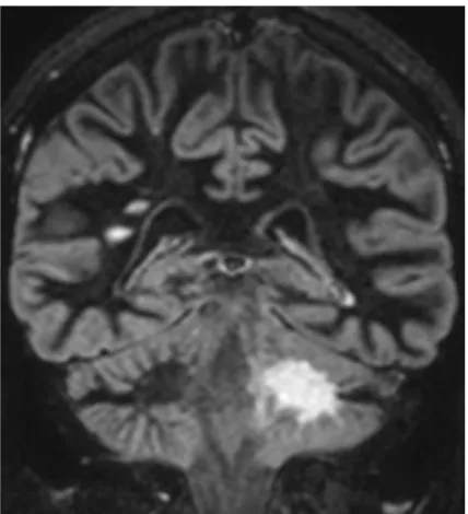 Figure 2: Contrast-enhanced axial T1W MRI at the level of the MCP (April 2014 study) shows no evidence of enhancement in the PML lesion.