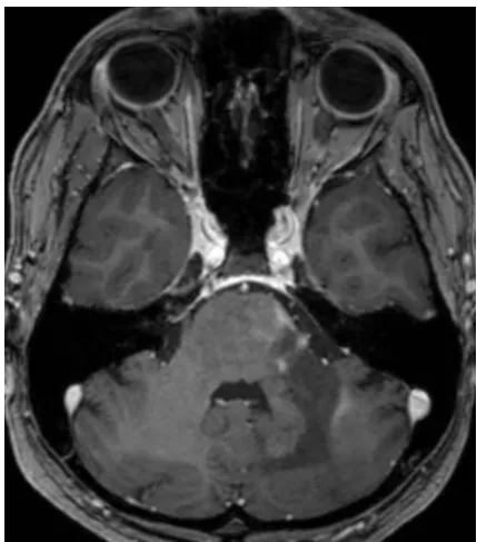 Figure 4: Contrast-enhanced axial T1W MRI at the level of the MCP (June 2014 study) shows an interval appearance of gadolinium enhancement at the margins of the PML lesion in keeping with IRIS.