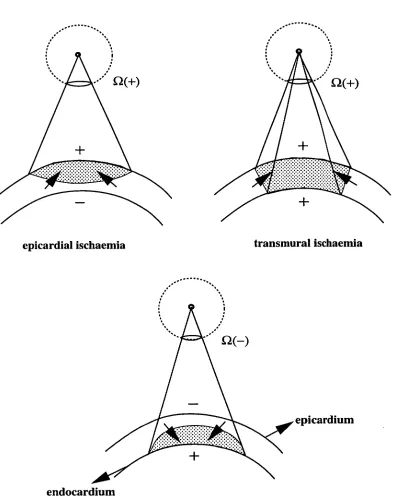 Figure 3.4: Magnitude and polarity of the solid angle as a function of ischaemic shape