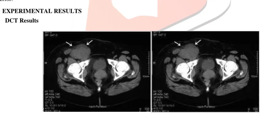Fig 5.1: (a) Original CT Scan Image (b) Compressed Image 