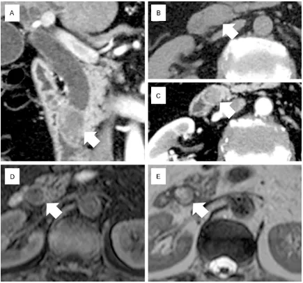 Figure 1. Computed tomography (A-C) and magnetic resonance imaging (D, E) findings. (A) The tumor (arrow) was located in the intrapancreatic common bile duct, measuring 20 × 18 mm