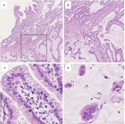 Figure 3. Microscopic findings. (A) The tumor was composed of intraductal and invasive components
