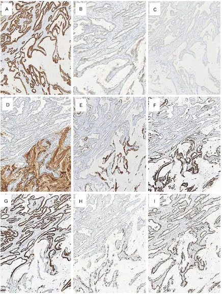 Figure 4. Immunohistochemical findings. A. Almost all the tumor cells were positive for CK7 (× 100)