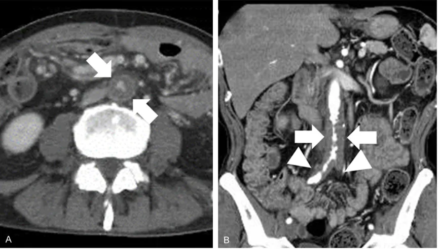 Figure 1. Contrast-enhanced computed tomography. A. Markedly narrowed intraluminal space with a thickened abdominal aortic wall (arrows)