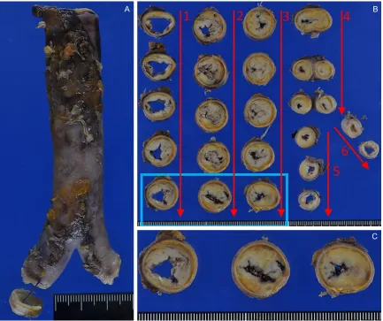 Figure 2. Microscopic findings of skin excision specimens. A. Representative specimen showed a tumor in the der-mis with a hemorrhagic appearance (1.25× magnification)