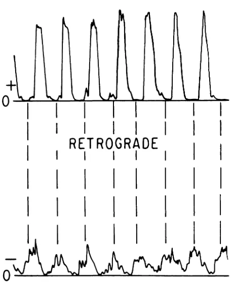 Fig 2.Velocity tracing from anterior cerebral artery ofand thus P1 = 1.0. Note retrogradeinfant 4 during ductal patency.Amplitudeof D is zeroflow occurs duringdiastole.