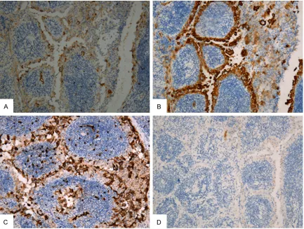 Figure 2. Immunohistochemistry staining. Neoplastic epithelial cells show positivity at membrane or cytoplasm for HBME-1 (A), 34βE12 (B), Leu-M1 (C), respectively (×100)