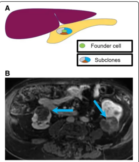 Fig. 7 Intratumoral heterogeneity.postcontrast MRI image acquired during arterial phase showingheterogeneously appearing renal cell carcinomas (blue arrows).Mutations can be missed at tissue sampling obtained from biopsies, a Image exemplifying theheteroge