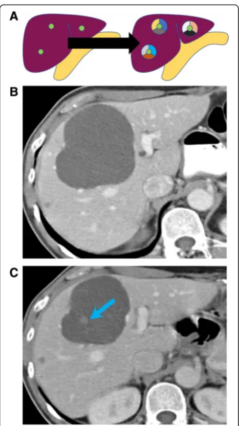 Fig. 8 Intermetastatic heterogeneity. a Image showing theheterogeneity within different liver metastases, each one arisingfrom a different subclone in a primary pancreatic tumor