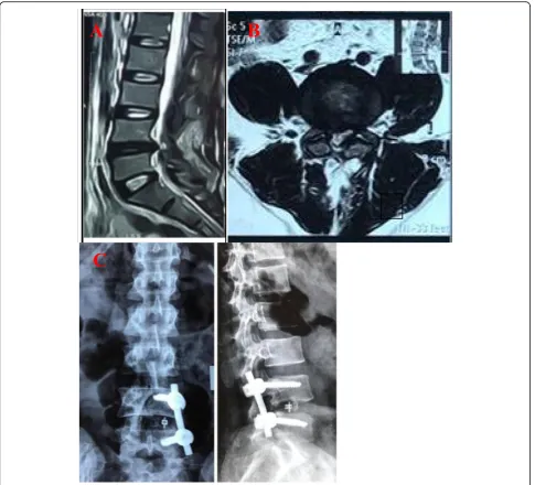Fig. 1 Images of 40-year-old female patient with recurrent L4–5 disc prolapse presented with LBP and Right sciatica