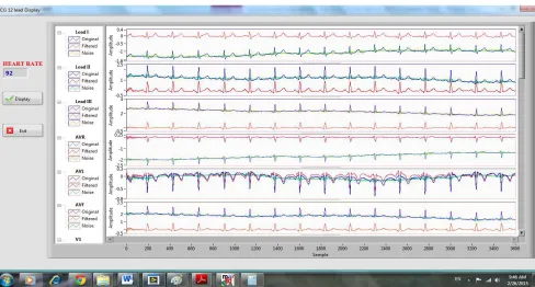 Figure 7. The experimental result of ECG database record number 117 from MIT-BIH. 