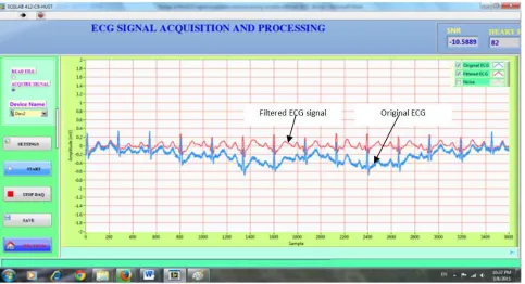 Figure 9. The experimental result of 12-lead ECG database record number patient243-s0472 from MIT-BIH (V1 lead to V6 lead)