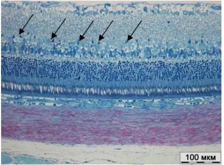 Figure 11. Experimental group. Equatorial area. Aggregation of erythrocytes in deep retinal capillaries (arrow)