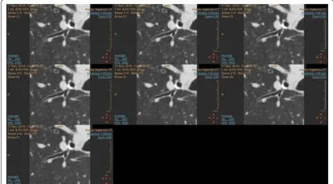 Fig. 1 Magnification of the lung parenchyma in a CT scan with the seven different iDose4 levels in ISP6: upper row iDose4 level 1 to 3; middlerow: iDose4 level 4 to 6; bottom: iDose4 level 7
