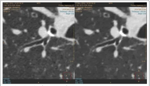 Fig. 2 Magnification of Fig. 1, left: iDose4 level 1 and right iDose4 level 6