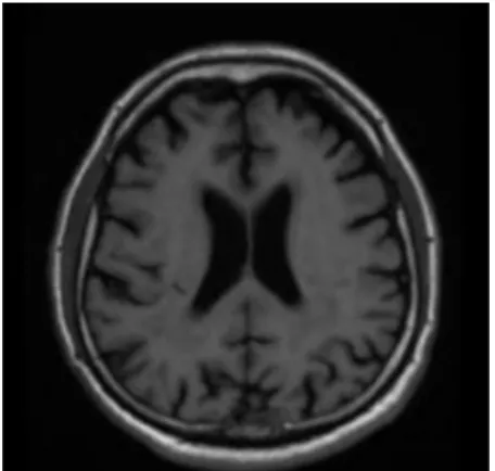 Figure 1. Axial FLAIR sequence shows symmetrically dilated ventricles with transependymal CSF flow (90 × 99 mm, 300 × 300 DPI)