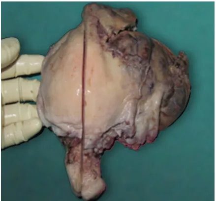 Figure  1:  Uterine ruptured at fundus exposing placenta tissue with intact amniotic sac and non-viable fetus in situ.