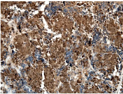 Figure 3. LRP16 expression in large cell neuroendo-crine carcinomas (LCNECs). LRP16 was stained posi-tive in the cytoplasm and nucleus of cancer cells