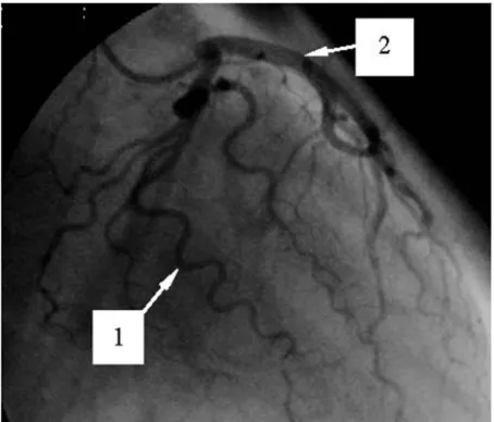 Figure 1. Coronarogram of the LCA with a severe pathological tortuosity of a few larger arteries