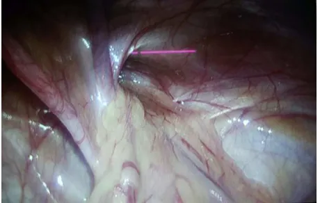 Figure 3. Purse-String Suturing of Hernial Sac. 