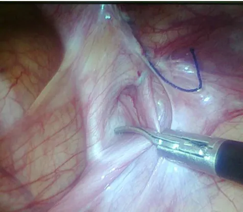 Figure 4. Small Sac in Case of Recurrence after Laparoscopic Herniotomy. 