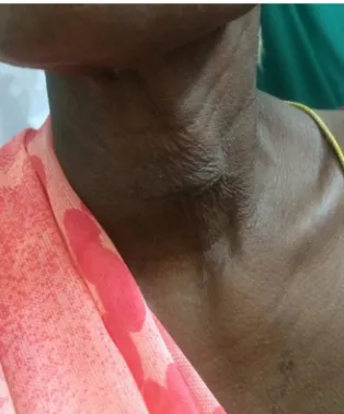 Figure 2. Scar 6 weeks after hemithyroidectomy without subcutaneous and skin closure. 