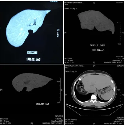 Figure 4. Liver regeneration in right lobe graft, 19yrs male donor. A. Whole liver preoperative 1332cm3