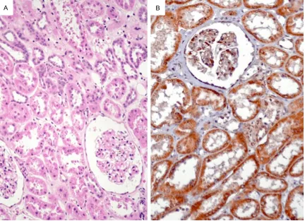 Figure 1. The EphA1 protein was positively expressed in normal renal tubes, but not expressed in renal glomerulus