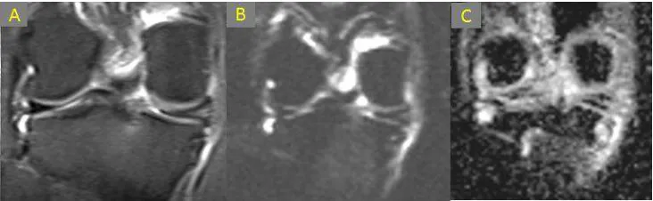 Figure 1. Medial meniscal tear presented with Proton Density Weighted (PDW) coronal fat saturated images (A) and DW image with b-value 50 mm2/sec 