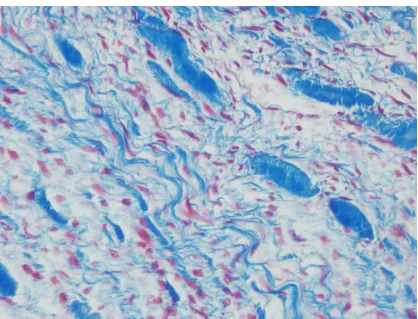Figure 4.B). Fibromyoma composing of thick collagen bundels and thin fibroblastic cellulary component (H&E) 