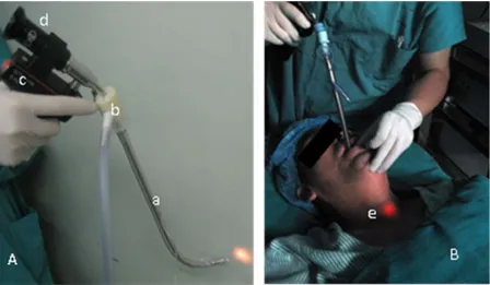 Figure 1. Endotracheal intubation with the Shikani optical stylet (SOS) A: The SOS is preloaded with an endotracheal tube