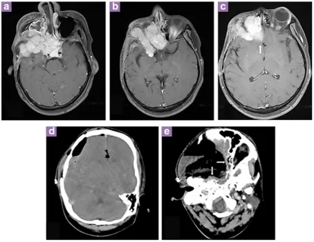 Figure 2: Contrast-enhanced MRI at second admission: A tumour recurrence with extension into the right cavernous sinus, part of the clivus, ethmoid and sphenoid sinuses (2a, 2b)