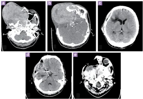 Figure 3: Contrast-enhanced CT at the third admission: The Mass increased in size, crossed the midline and involves the entire frontal, ethmoid and sphenoid sinuses as well as the entire clivus and cavernous sinuses (3a, 3b); it has extended into the bifro