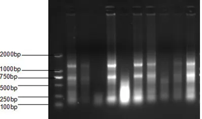 Figure 3. Agarose gel electrophoresis of total RNA ex-tracted from breast cancer, adjacent normal tissue and fibroadenoma
