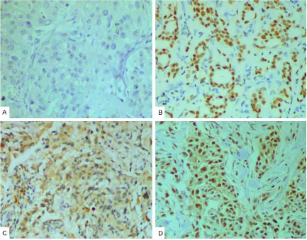 Figure 1. Immunohistochemical staining of PARP1 in breast cancer samples (original magnification ×200)