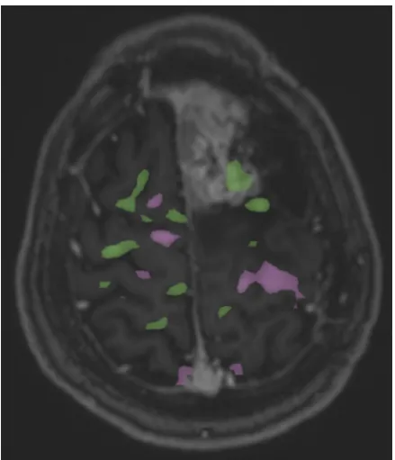 Figure 2: Functional magnetic resonance image of the hand motor task showed cortical activation in the middle part of left precentral gyrus (purple colour).