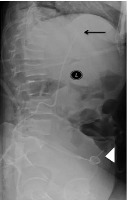 Figure  1: Computed tomography fluoroscopy showing the puncture needle (white arrow) approaching the infrarenal inferior vena cava (white arrowhead).