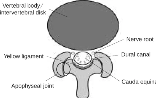 Fig. 2 Intervertebral disk-level stenosis (nerve root type) The nerve root is compressed by a bone spur generated by deformity of an apophyseal joint.