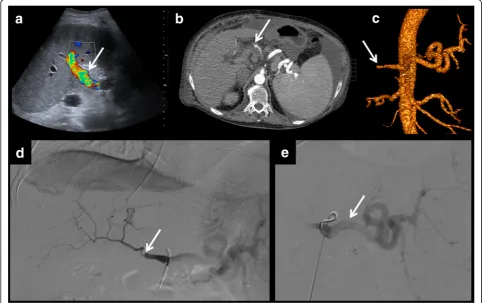 Fig. 6 Hepatic artery stenosis leading to splenic artery steal syndrome. Postsurgical US shows a turbulent flow of the hepatic vein