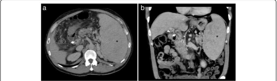 Fig. 22 Axial CT in the same patient demonstrates a filling defectwithin a branch of the superior mesenteric vein