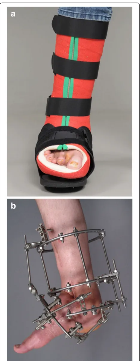 Fig. 5 a Removable total contact cast used for off-loading treatmentof active Charcot foot